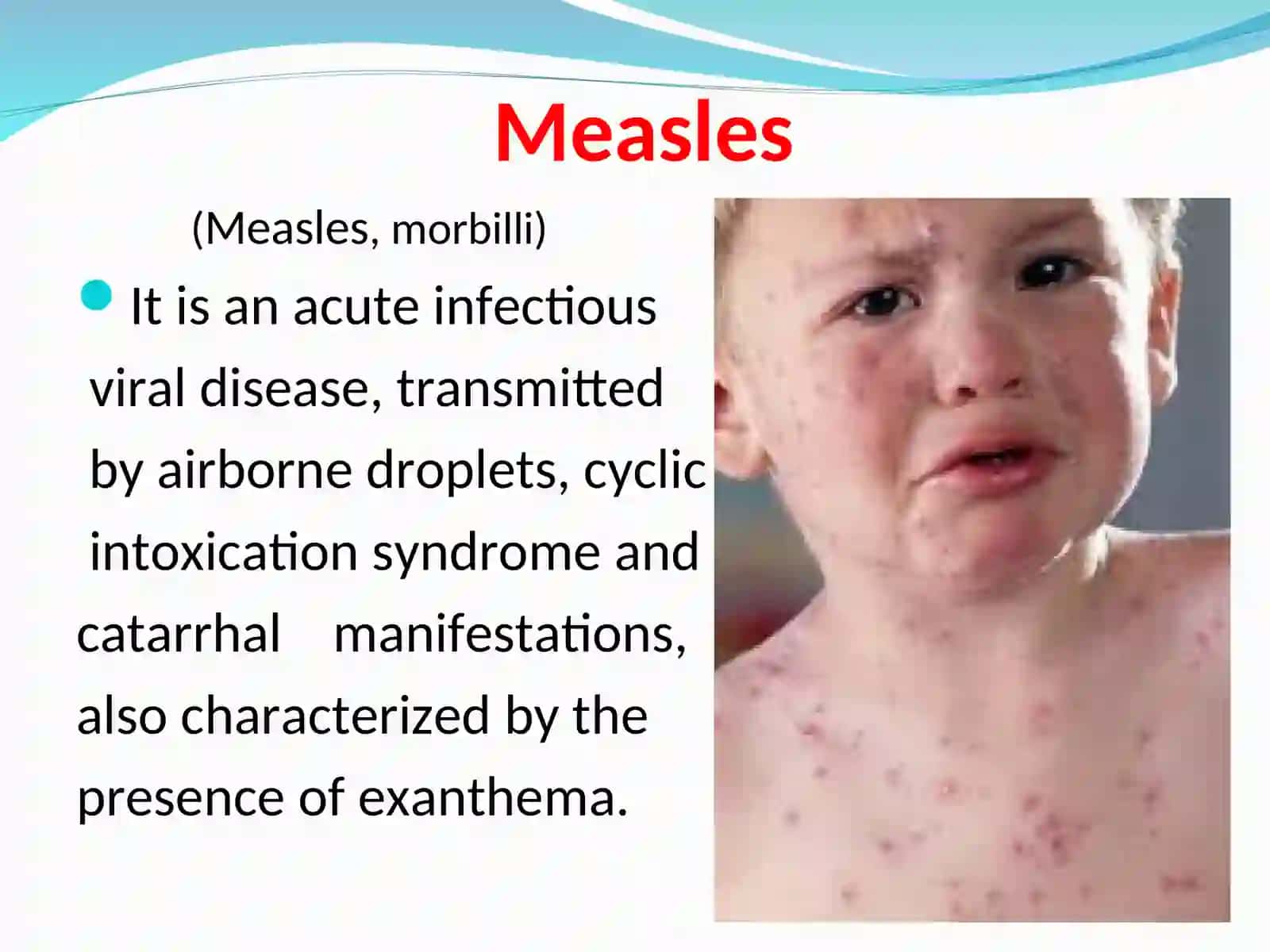 Measles. Rubella 3