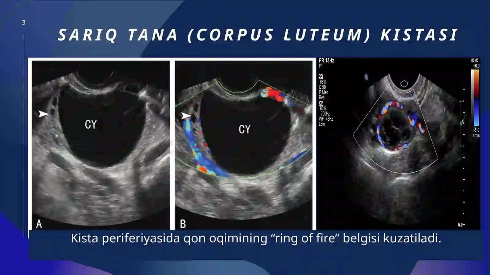 Tuxumdonlar kistasida UTT diagnostikasi 3