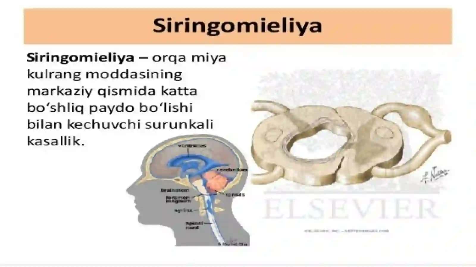Siringomiyeliya 3
