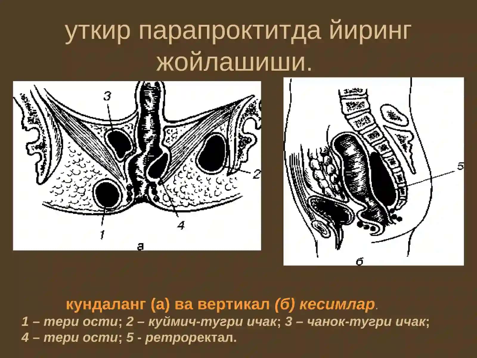 Парапроктит 3