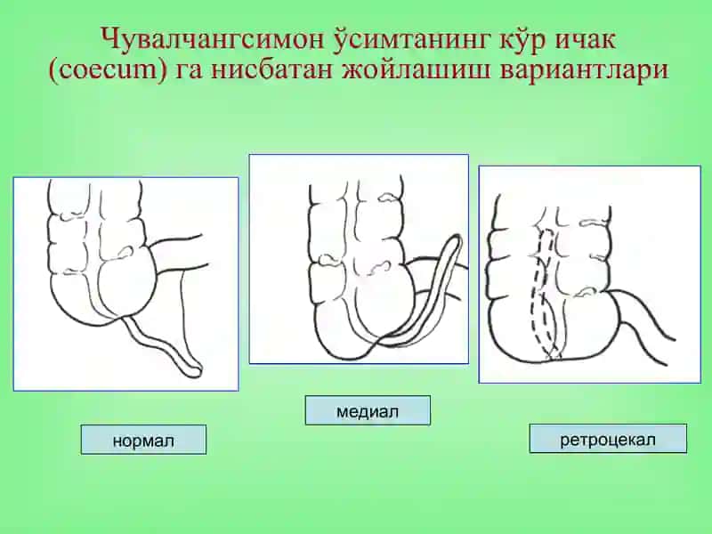 Ўткир аппендицит 3