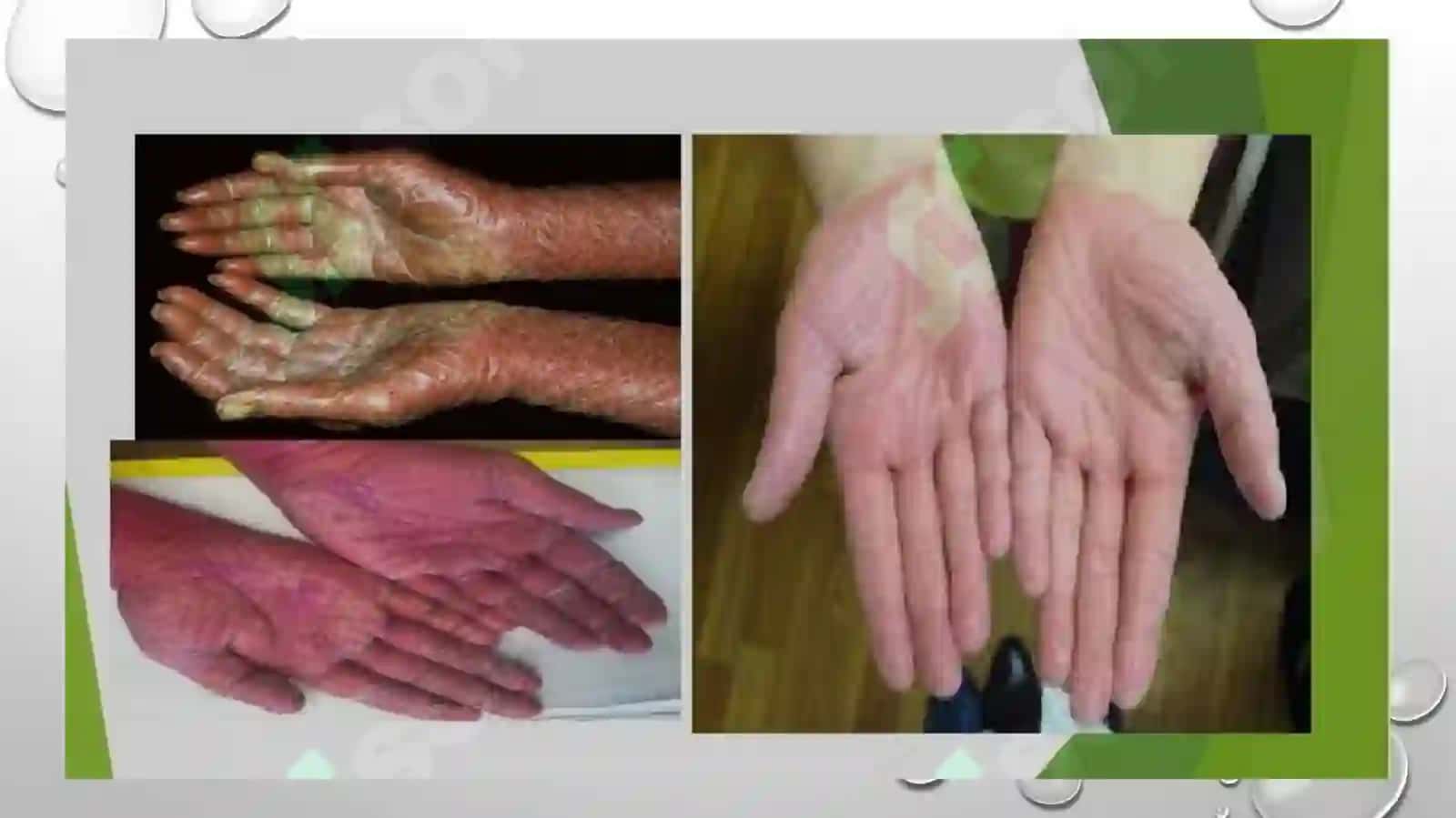 Deverji kasalligi. Psorioz va QYaT atipik turlari. Jiberning pushti rangli temiratkisi 3