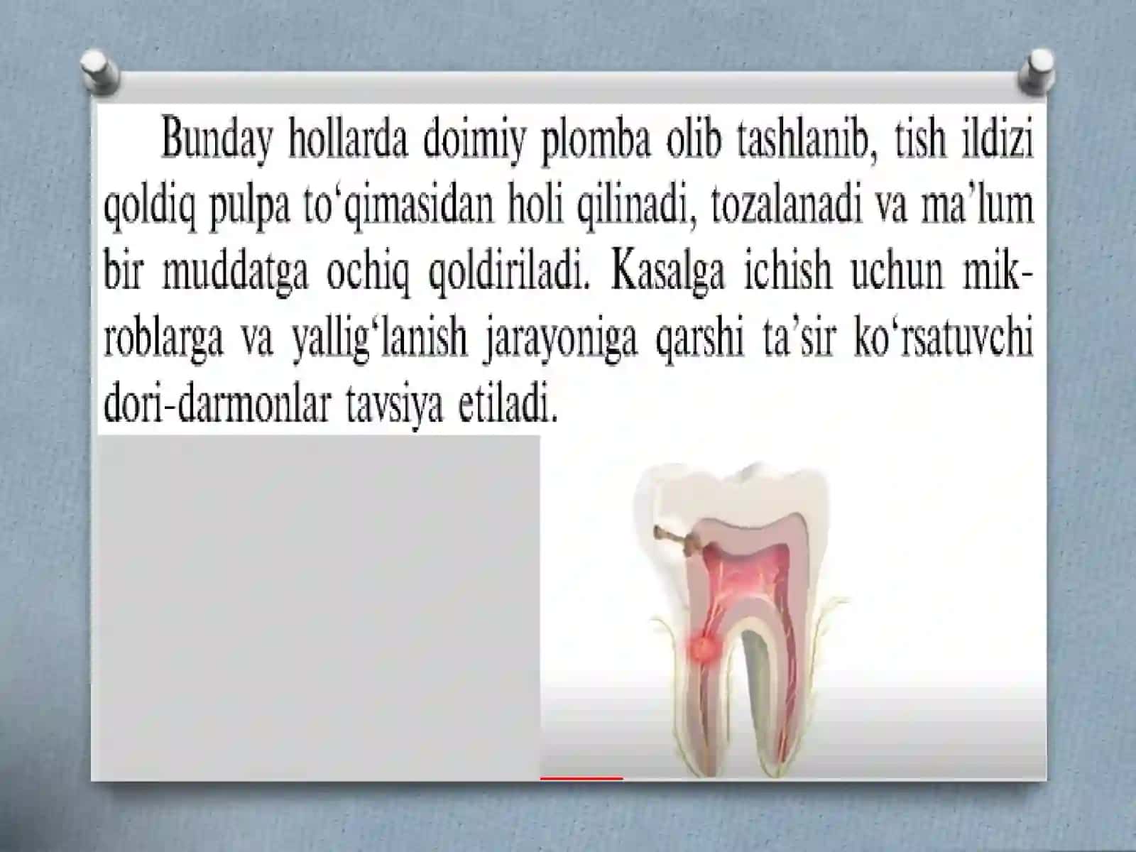 Pulpitlarni davolashdan so’ng (davomiy vaqtdan keyin) yuzaga keluvchi asoratlar. 3