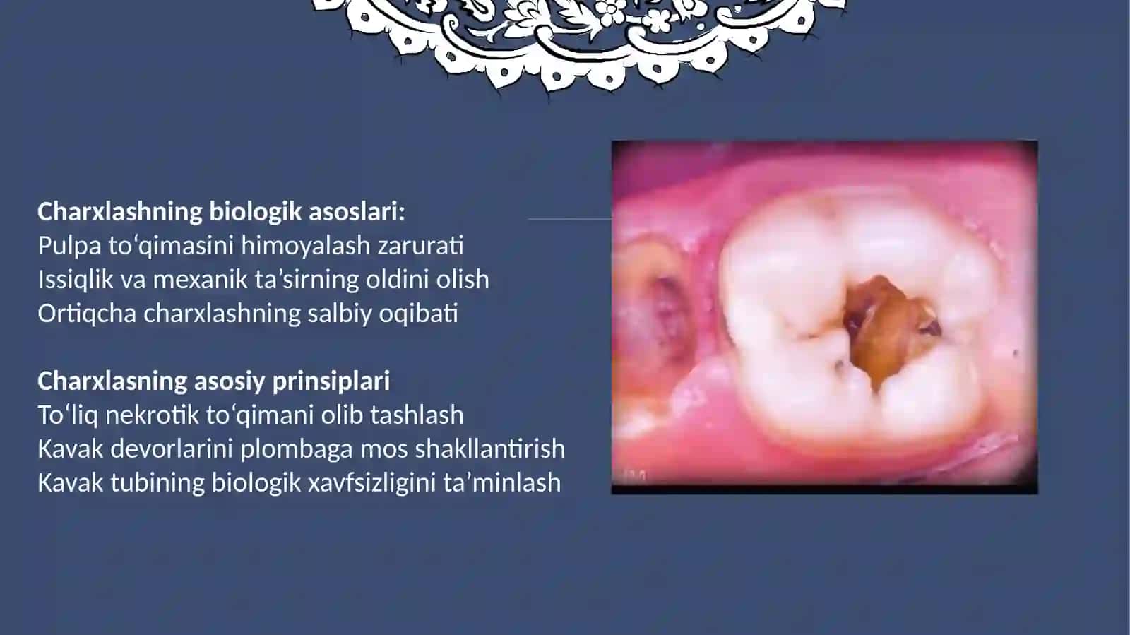Fantomlarda 6-sinf karioz bo'shliqlarini charxlash va plombalash 3