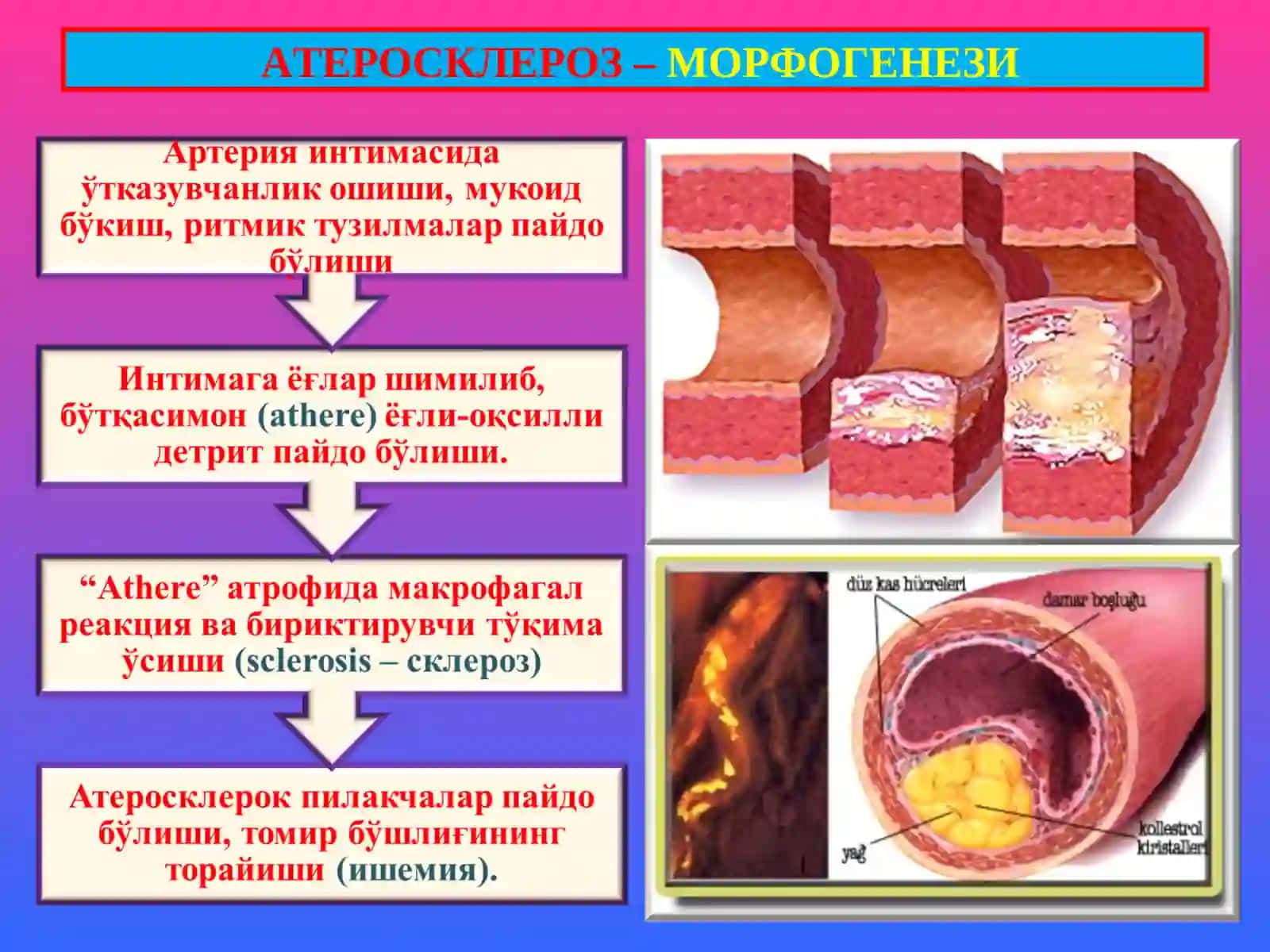 ТОМИР КАСАЛЛИКЛАРИ -АТЕРОСКЛЕРОЗ 3