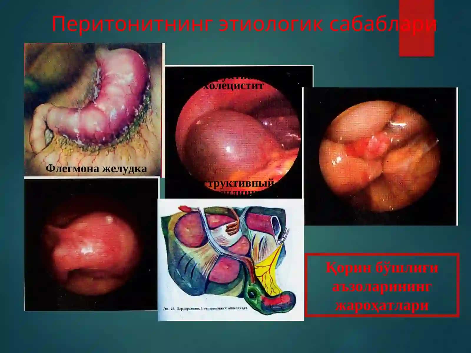 уткир перитонит 3
