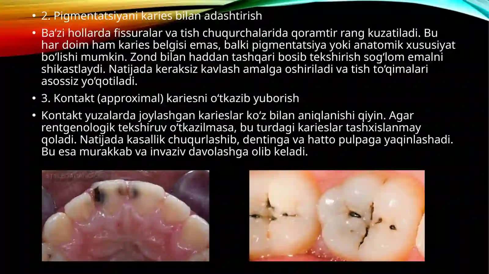 Kariyes kasalligini tashxislashda va davolashda uchraydigan xato va asoratlar.Kariyes kasalligini profilaktikasi.Kariyesni profilaktik omillar guruhi haqida malumot 3