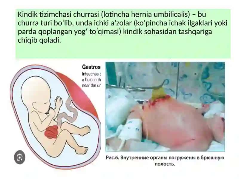 Kindik tizimchasi churrasi haqida umumiy ma'lumot 3