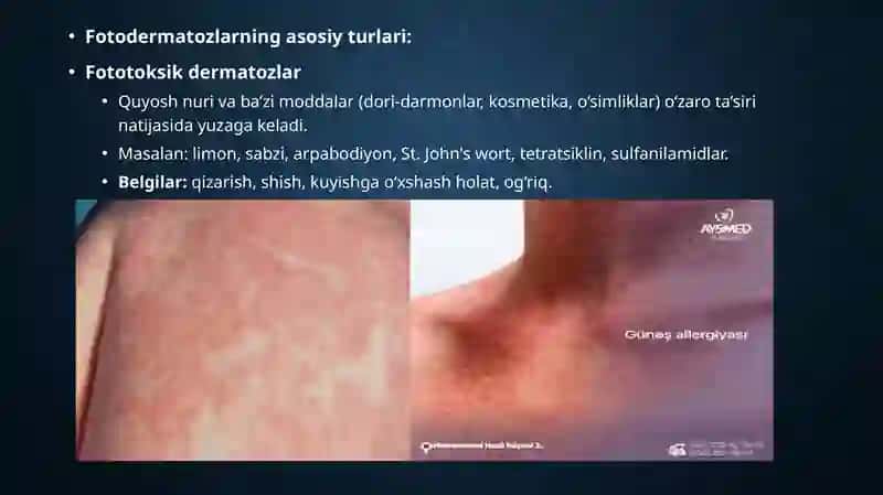 Fotodermatozlar 3
