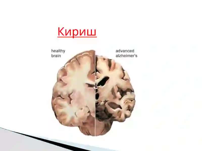 АЛЬЦГЕЙМЕР КАСАЛЛИГИ 3