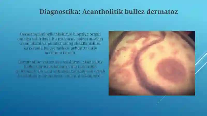 Pufaklidermatozla.Akontalitikpo'rsildokyara.Dyurinubguchuqsilomdermatiti 3