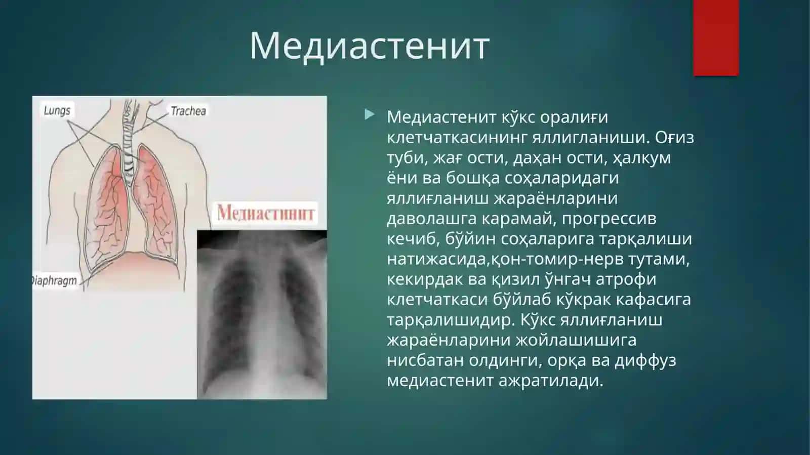 Медиастенит 3