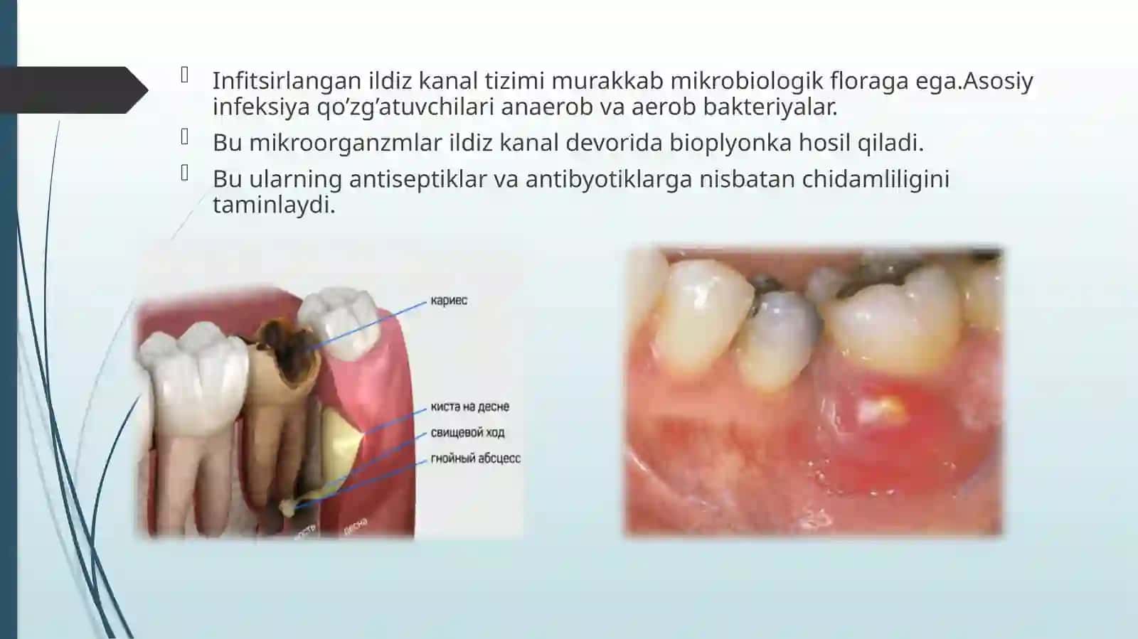 Infitsir langan ildiz kanal tizimi 3