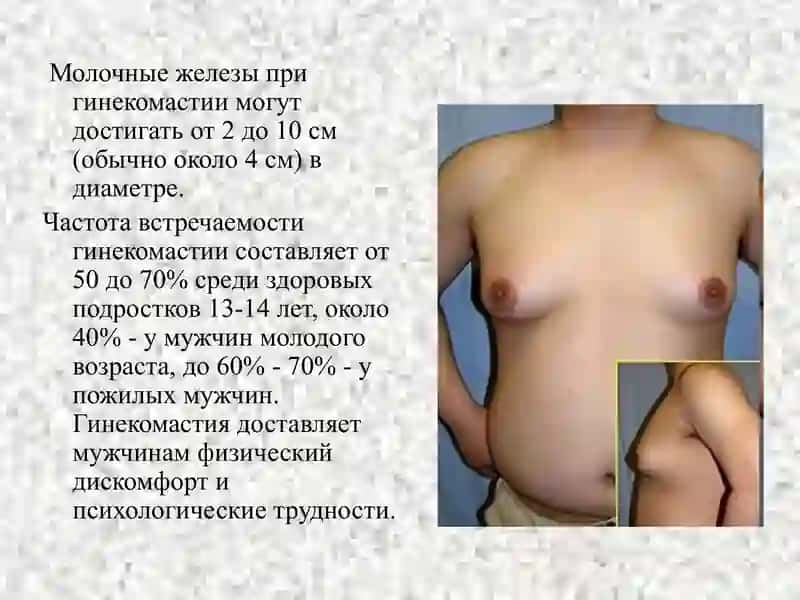 Гинекомастия 3