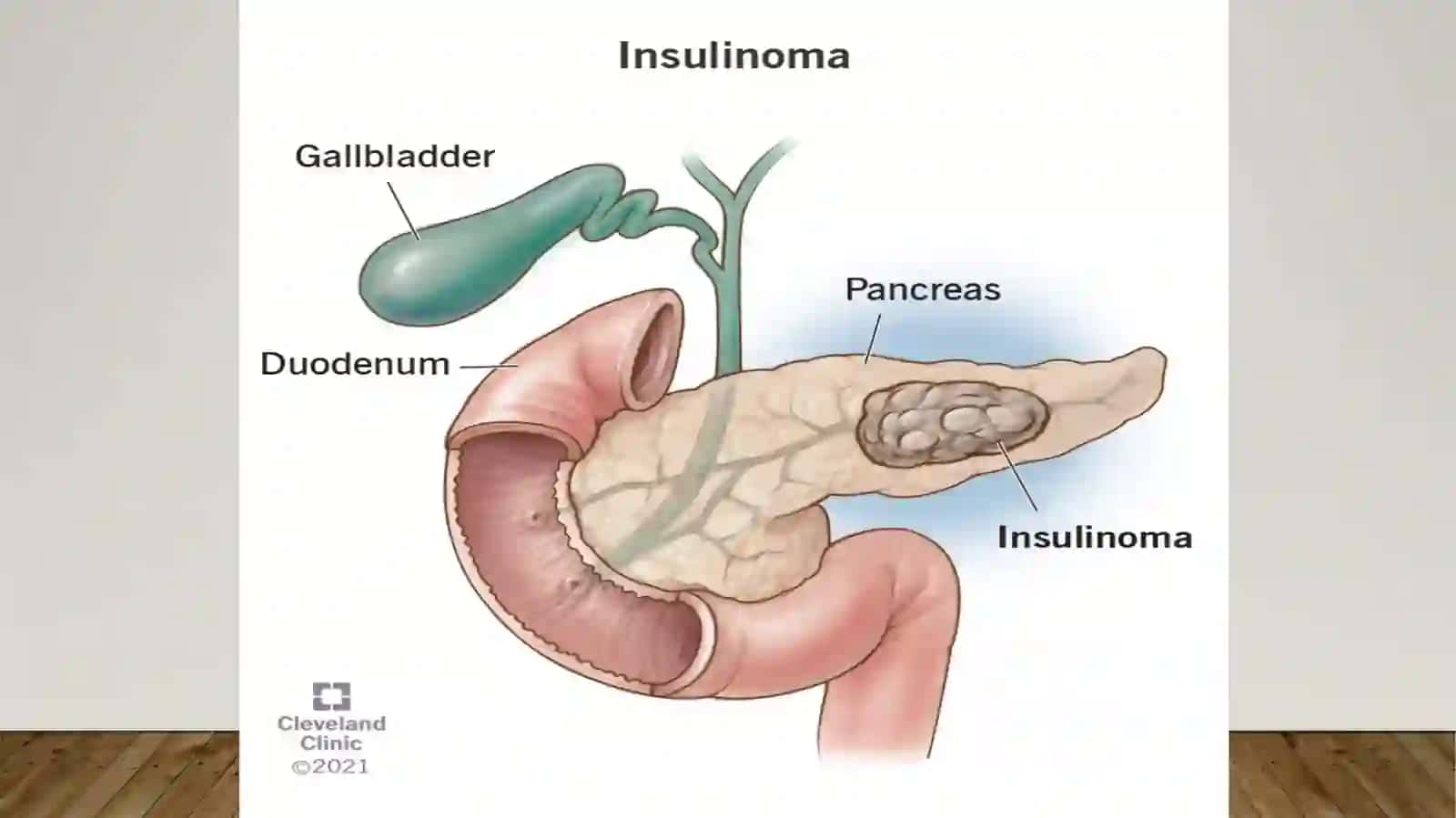 Insulinoma 3