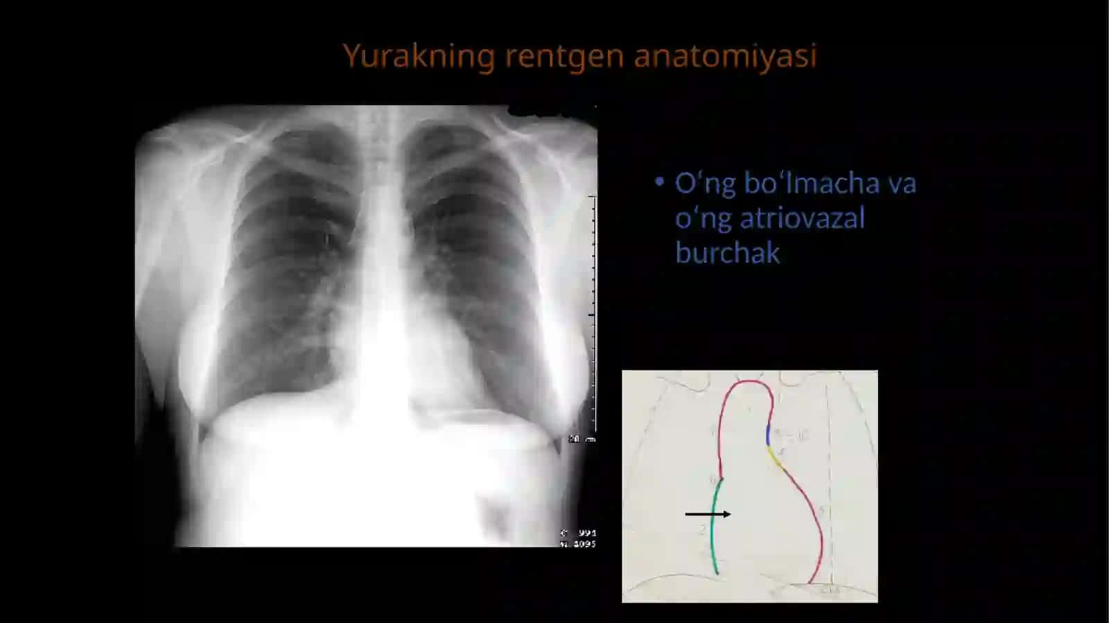 Yurak rentgenografiyasi 3