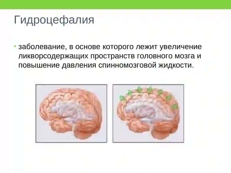 Гидроцефалия 3