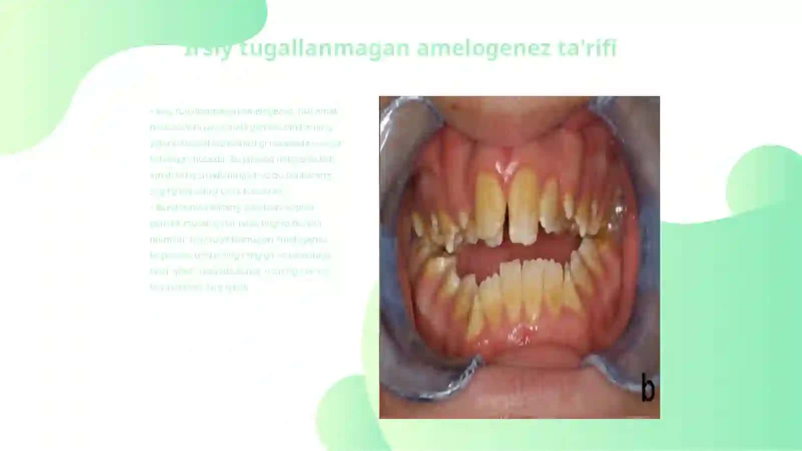 Irsiy tugallanmagan amelogenez 3