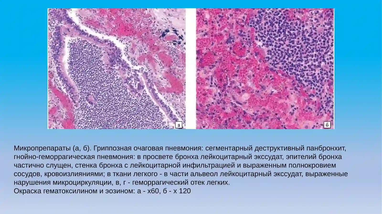Макропрепараты (а, б). Очаговая пневмония при гриппе («большое пестрое гриппозное легкое» сабсцедированием) 3