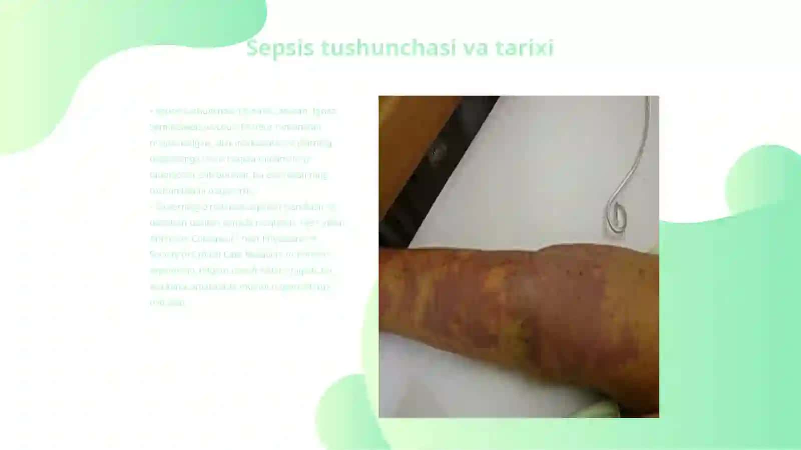Sepsisning zamonaviy tasnifi 3