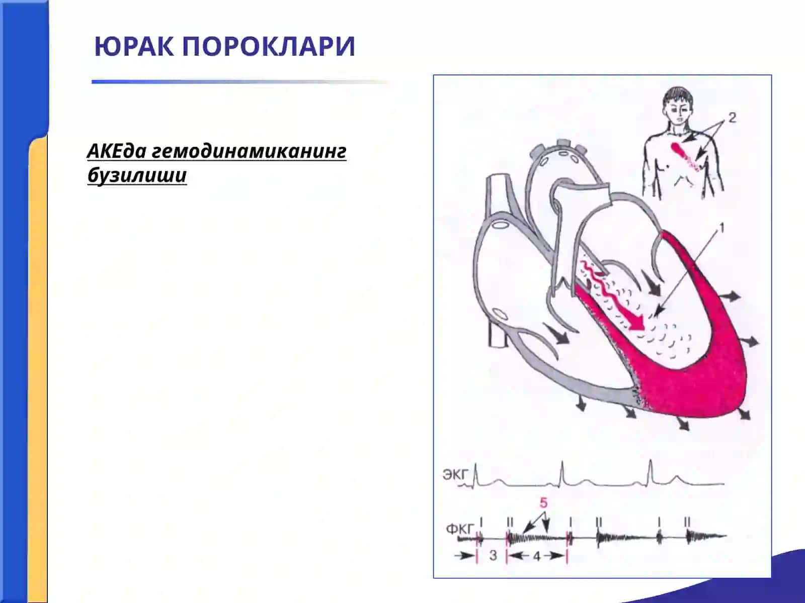 ЮРАК ПОРОКЛАРИ. АОРТА КЛАПАНИНИНГ ЕТИШМОВЧИЛИГИ.АОРТА ОҒЗИНИНГ СТЕНОЗИ.ҚОН АЙЛАНИШИ ЕТИШМОВЧИЛИГИ 3