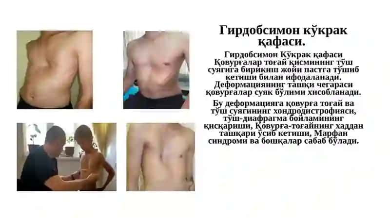 Кўкрак қафаси ва ўпканинг туғма ривожланиш нуқсонлари ва аномалиялари 3