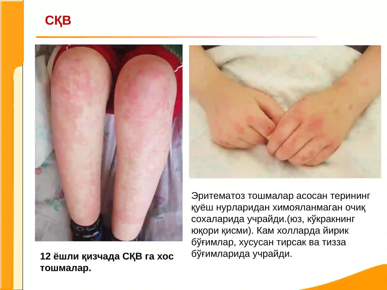 Системали кизил волчанка 3