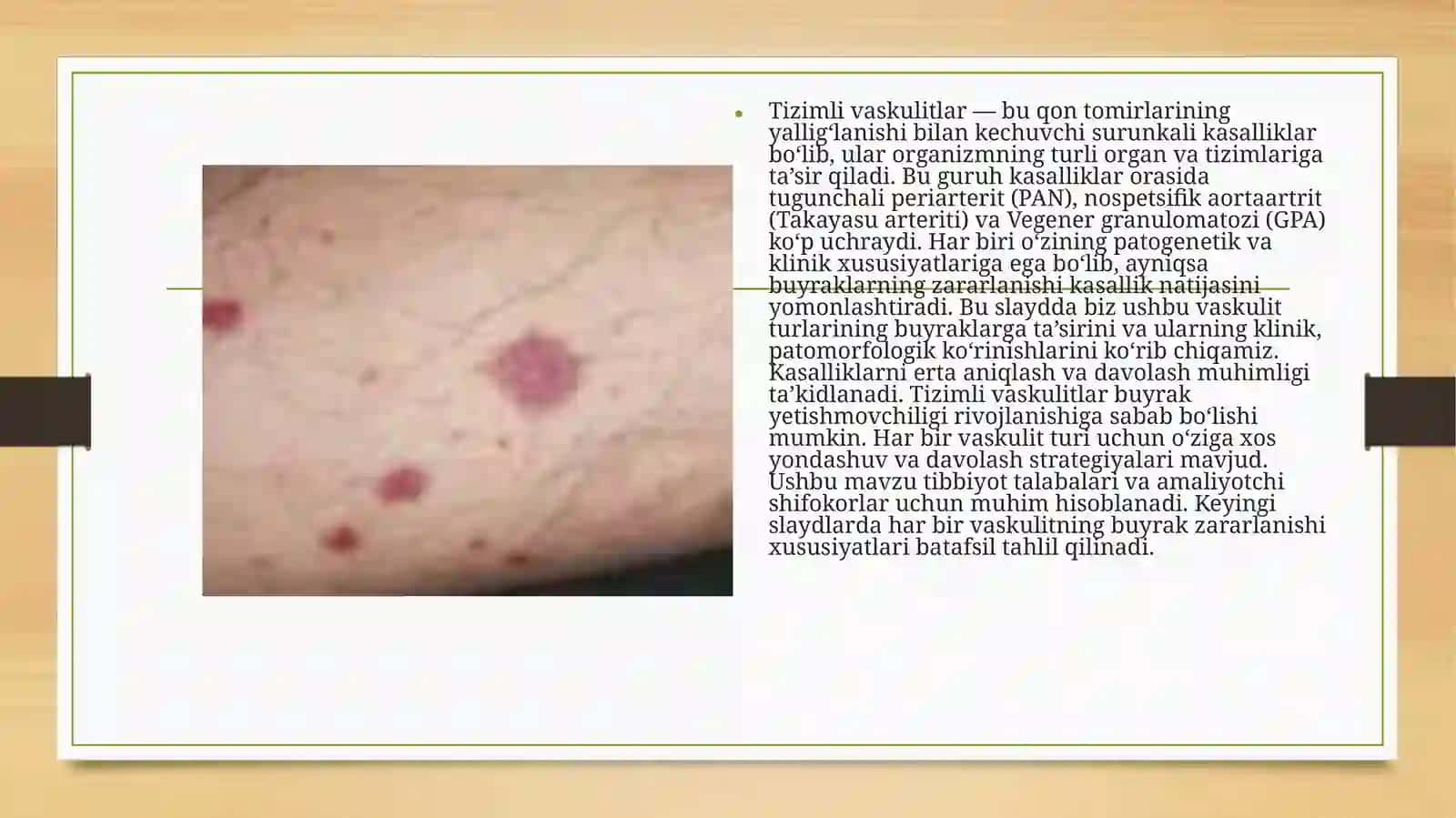 Tizimli vaskulitlar(tugunchali periartrit, nospetsefik aortoartrit, Vegener granulematozi)da buyraklarning zararlanishi xususiyatlari 3