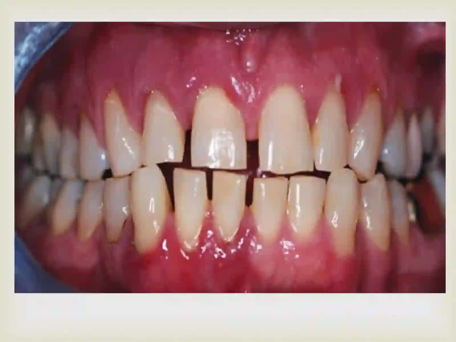 Atrofik gingivitni klinikasi,diagnostikasi, qiyosiy tashxisi, davolash, profilaktikasi. Kasallik tarixini yozish. Kasallik tarixini yozish. 3