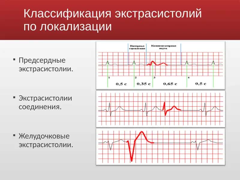 Экстрасистолии 3