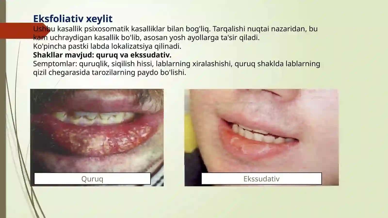 XEYLIT KASALLIGI 3