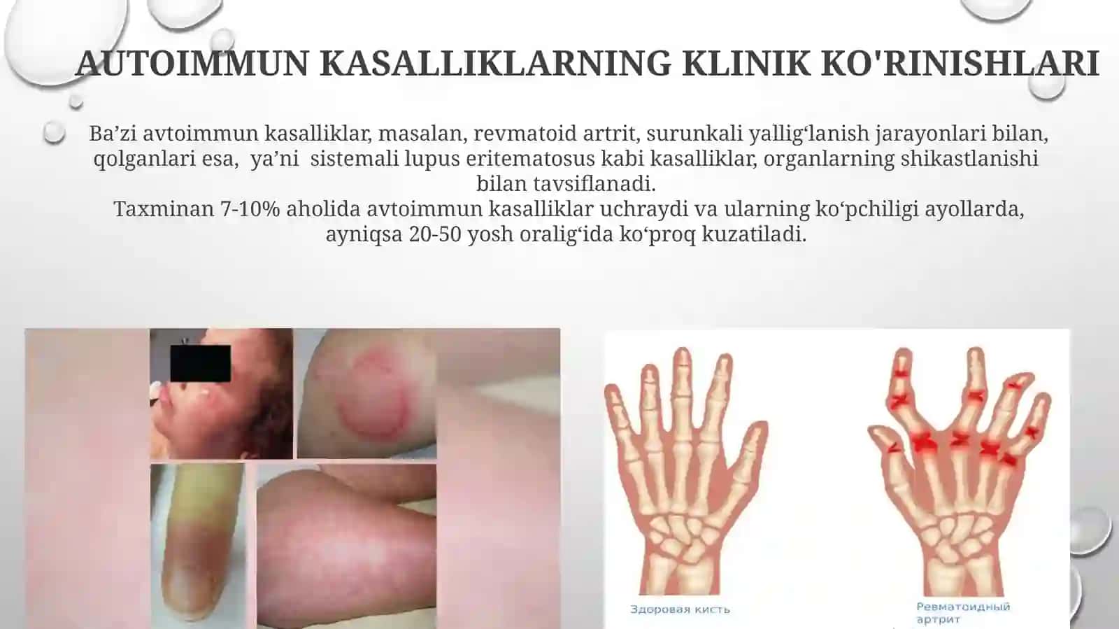 Autoimmun Kasalliklarning Klinik Ko'rinishlari 3