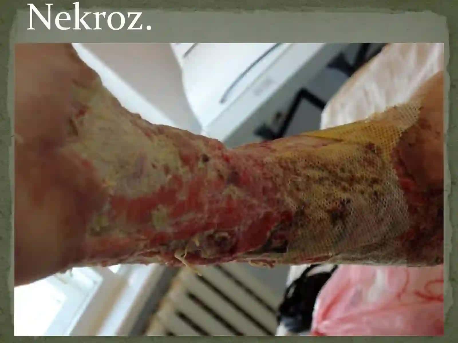 Mikrosirkulyator qon aylanishining buzilishi. Nekroz , gangrena, yaralar, oqmalar, yotoq yaralari 3