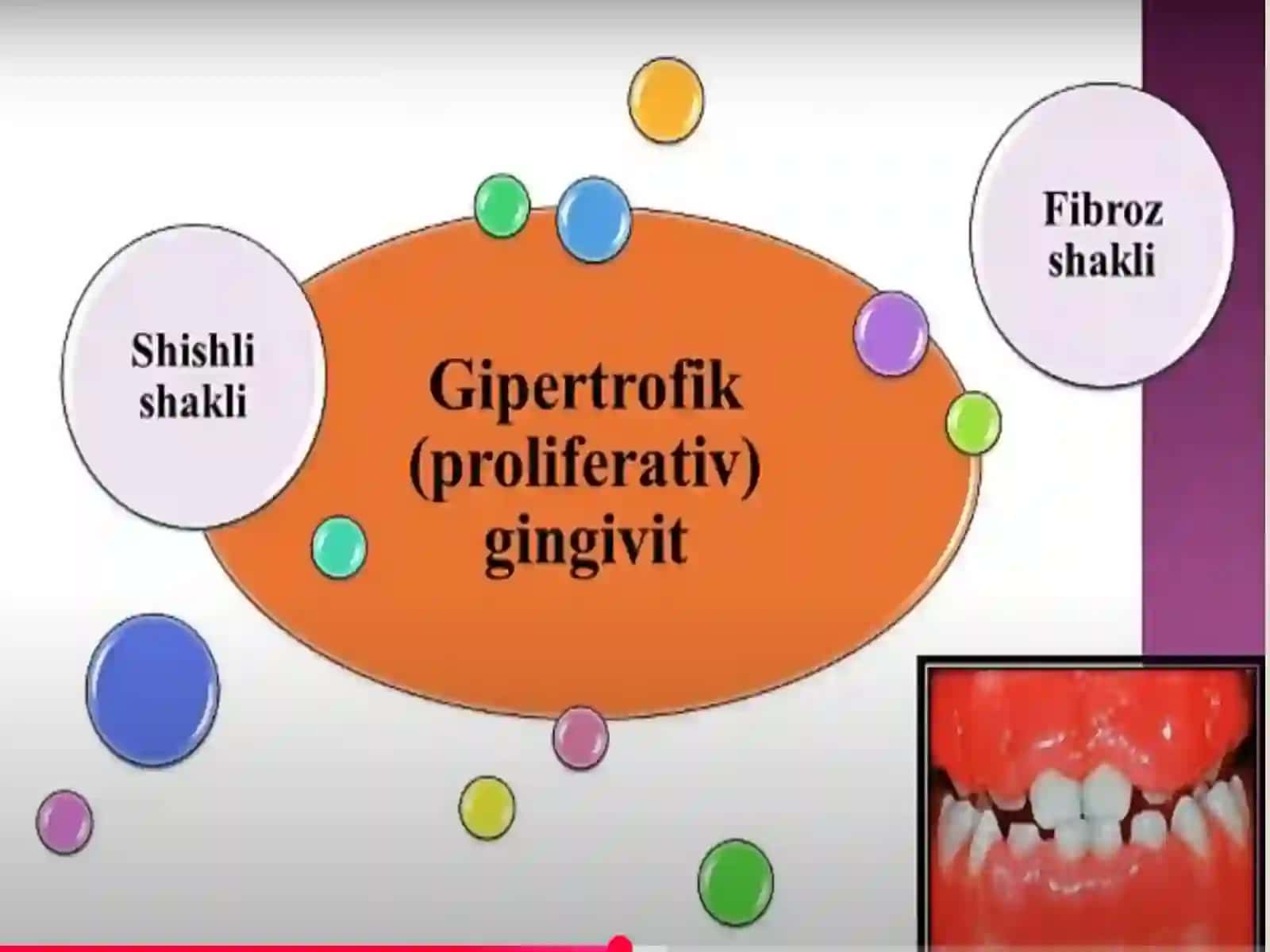Gipertrofik gingivit. Klinikasi,diagnostikasi, qiyosiy tashxisi, davolash, profilaktikasi. 3