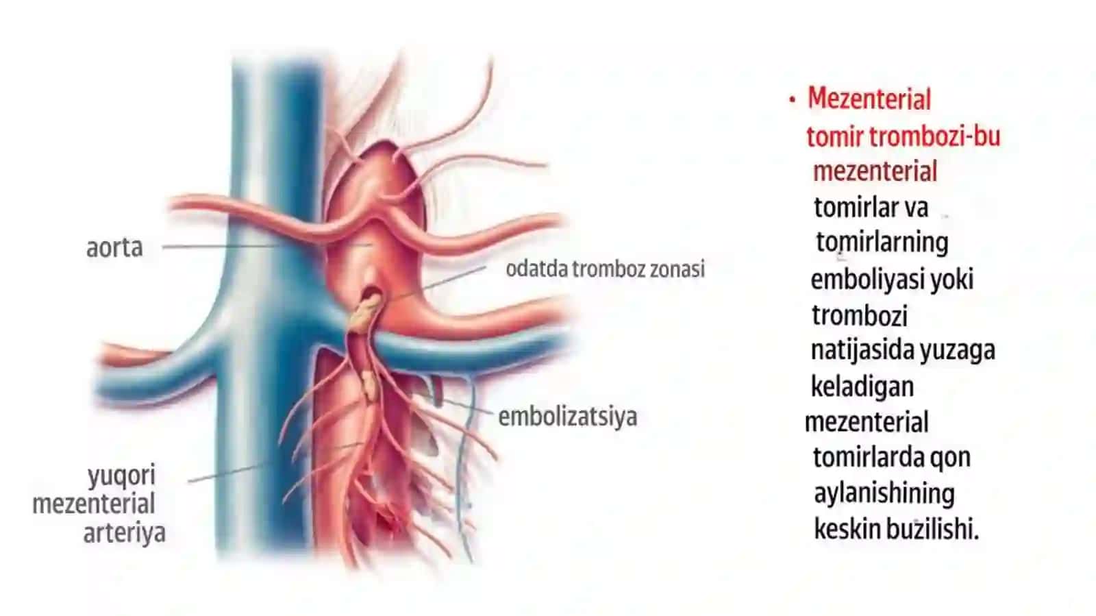 Mezenterial trombozlar 3