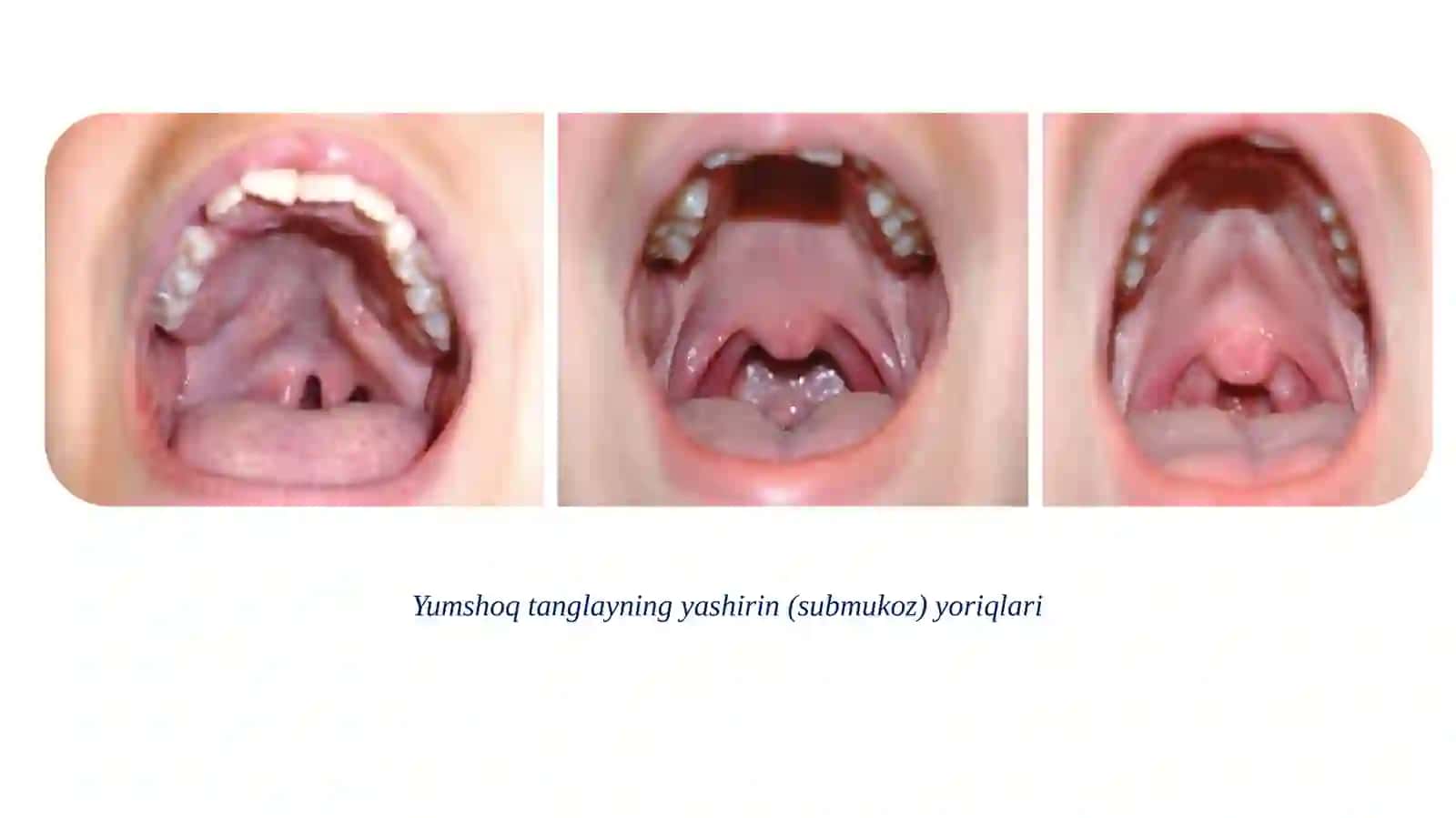 YUQORI JAG‘ VA TANGLAYNING ORTTIRILGAN HAMDA TUG‘MA DEFEKTLARINI ORTOPEDIK DAVOLASH 3