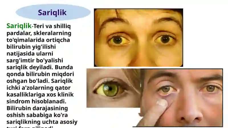 Sariqlik sindromlari 3