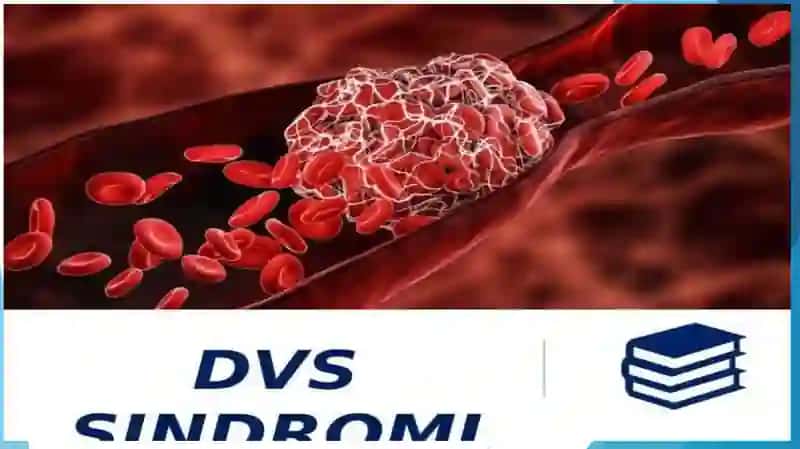 DVS sindromi 3