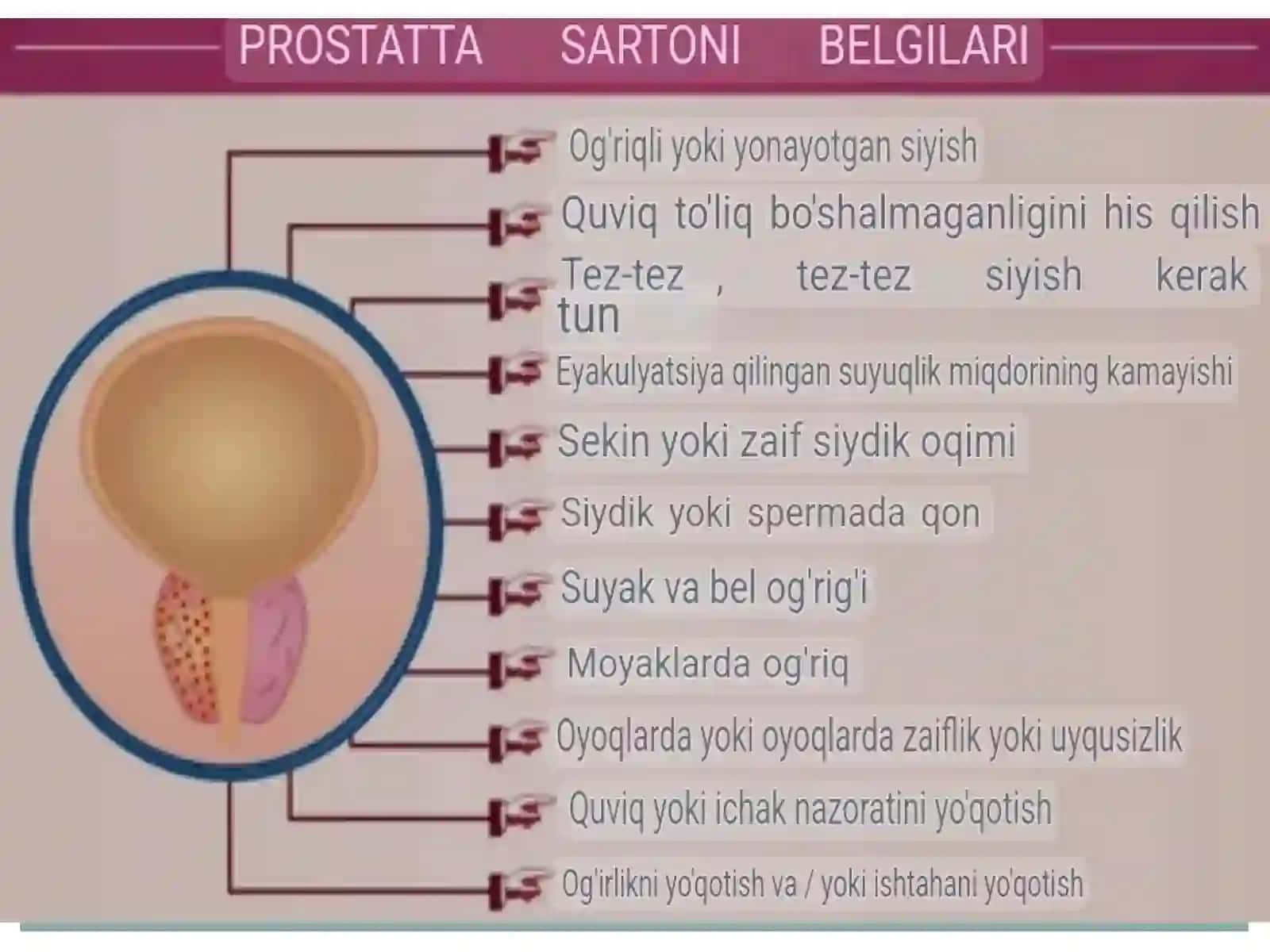 Prostata bezi o’smalari 3