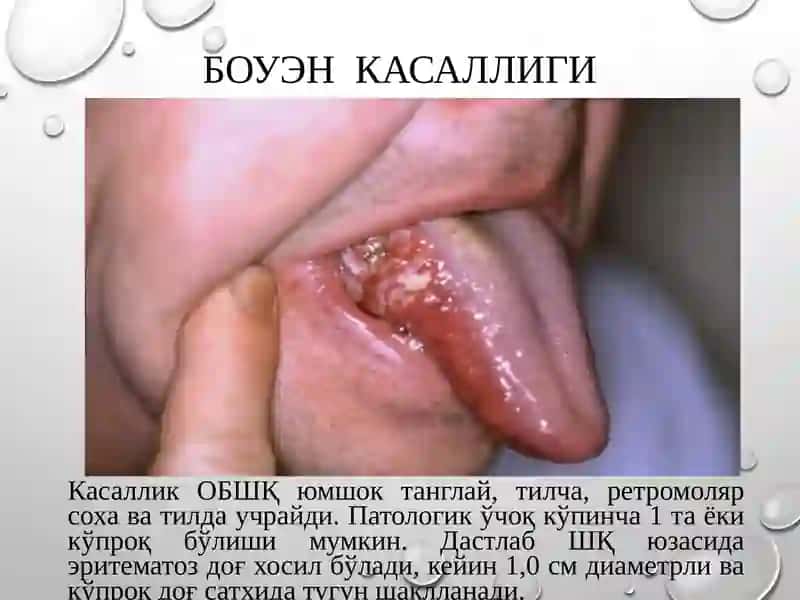 Стооматология саратонолди касалликлари 3