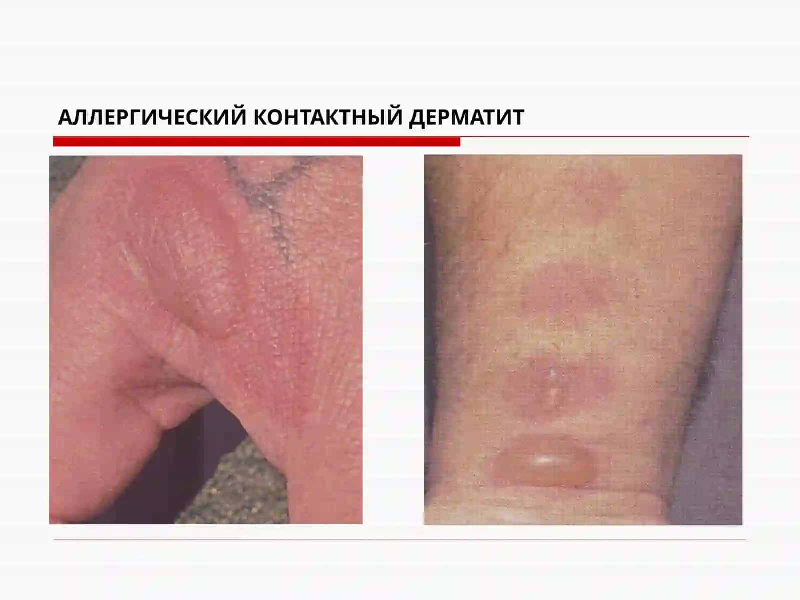 Аллерго ванейродерматозлар 3