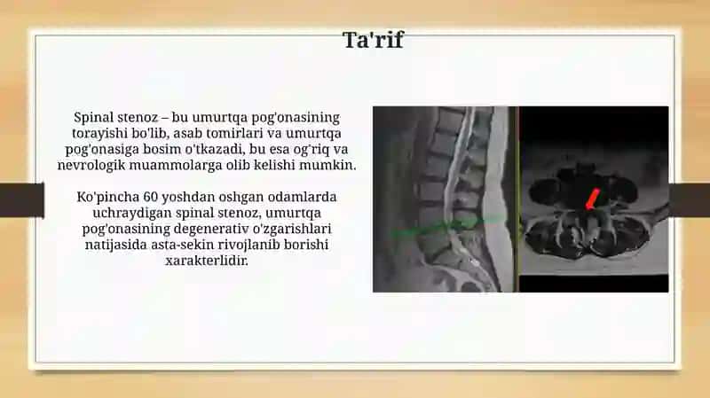 Umurtqa kanali stenozi 3