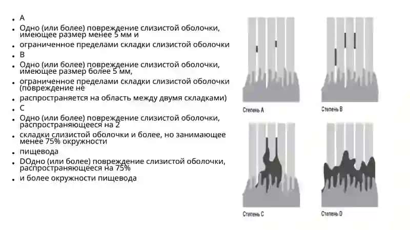Гастроэзофагеальная рефлюксная болезнь 3