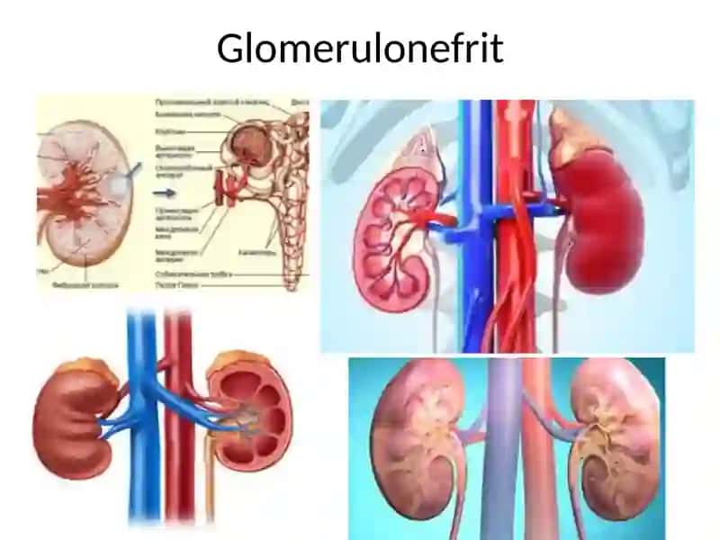 Glomerulonefrit 3