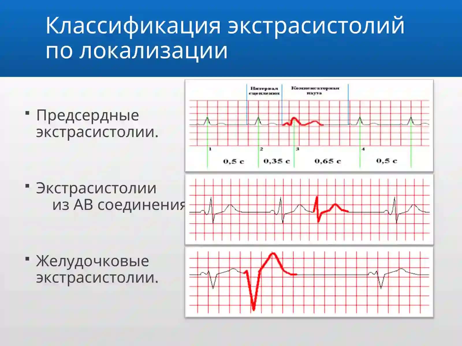 Экстрасистолия 3