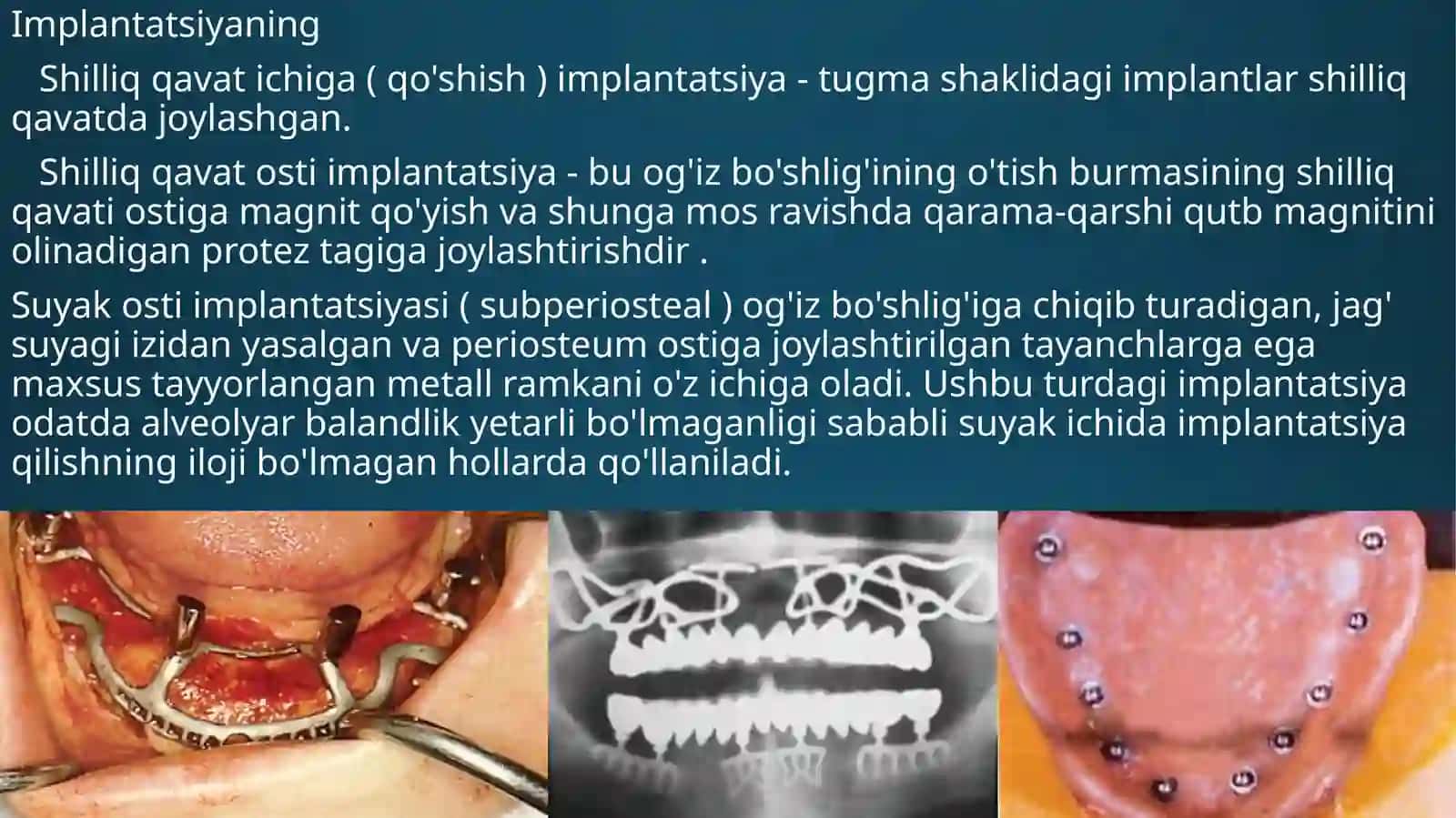 To'liq olib qo'yiladigan protezlarni implantlar bilan fiksatsiya qilish turlari 3