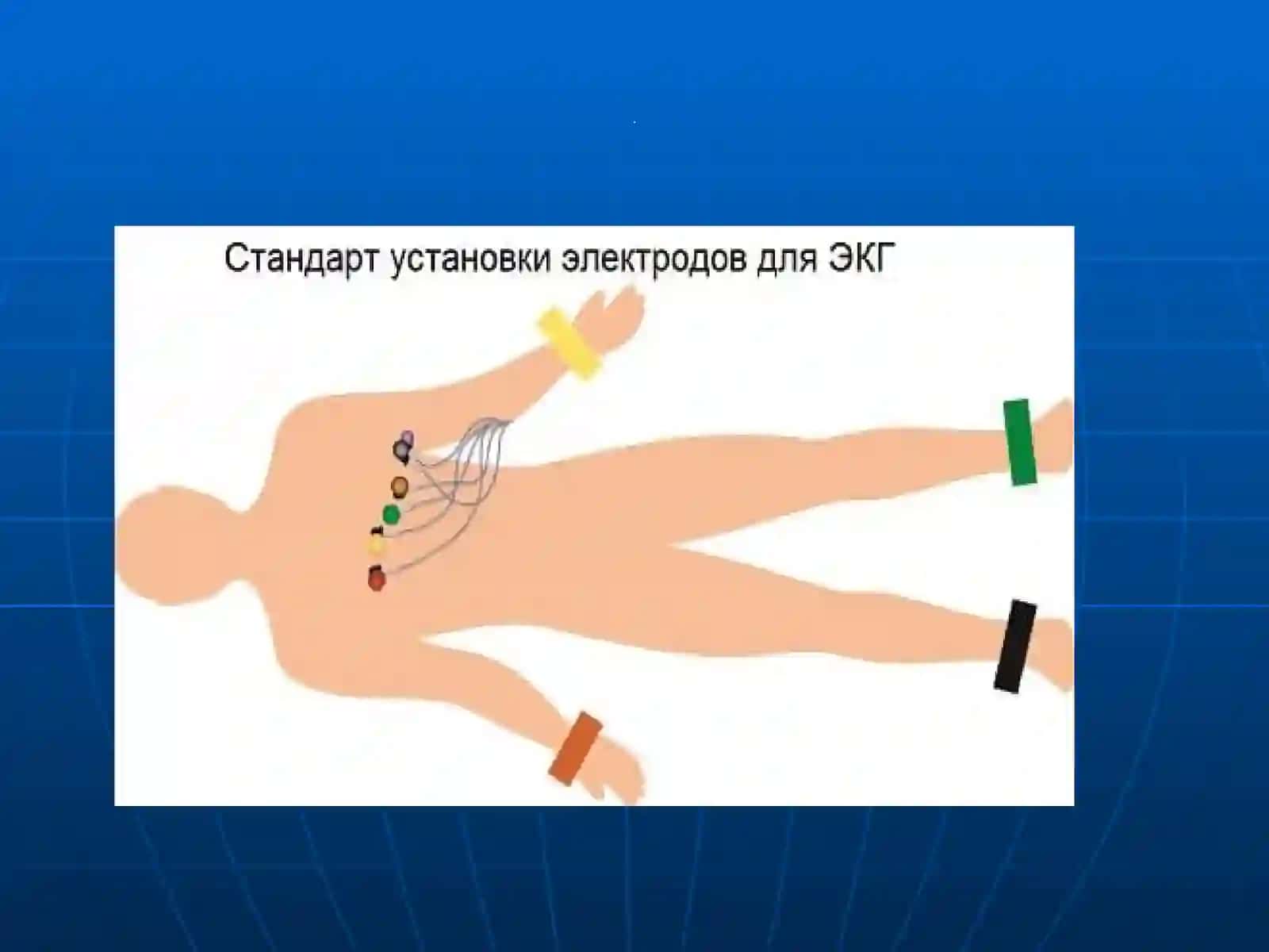 EKG va ExoKG haqida tushuncha 3