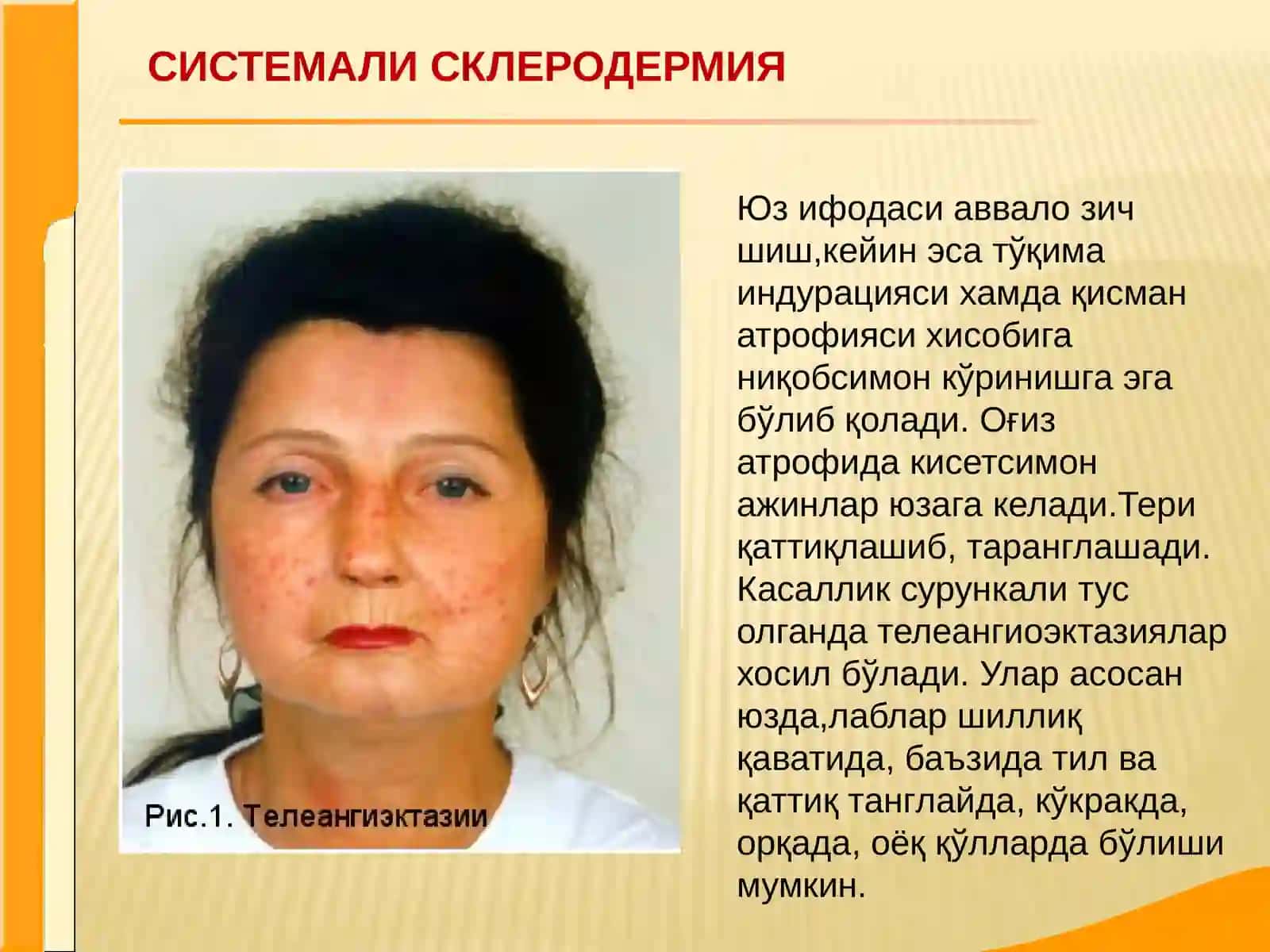 Системали склеродермия 3