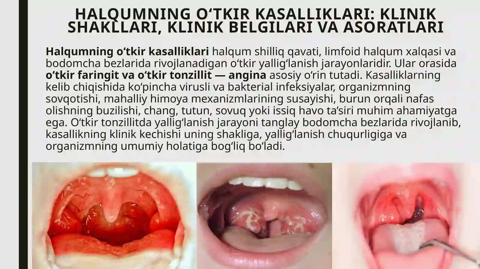 Halqumning o‘tkir va surunkali kasalliklari — klinik shakllari, asoratlari. Klinik belgilari, taxminiy tashxisni shakllantirish, tekshirish rejasini tuzish. Paratonzillyar abssess. Adenoidlar gipertrofiyasi 3