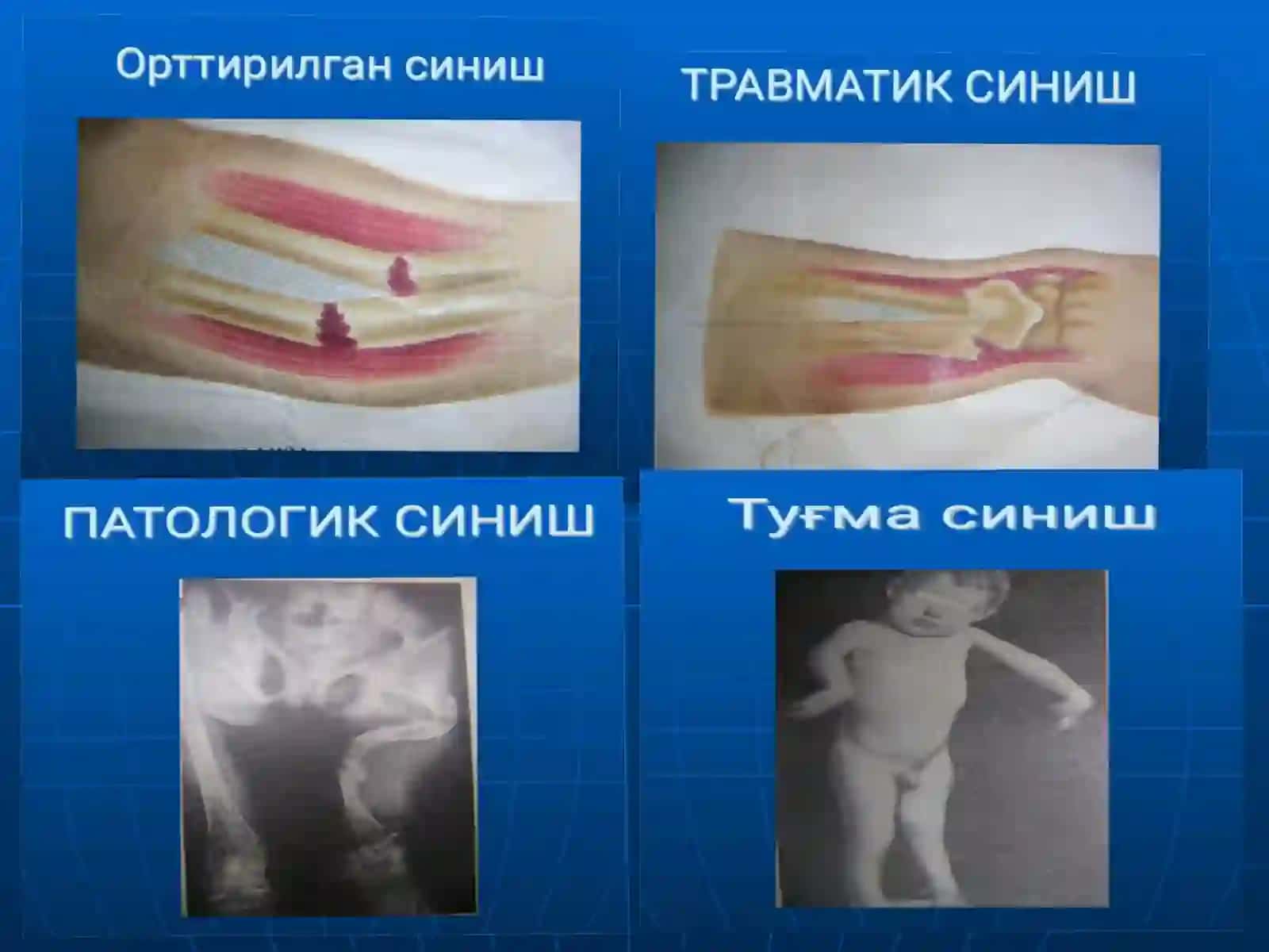 Tayanch harakat apparati ishlarining tashxislash. Birinchi tibbiy yordam. Transportli immobilizatsiya. Gipsteknikasi. Skelet va leykoplastir tanasi ortmasi 3